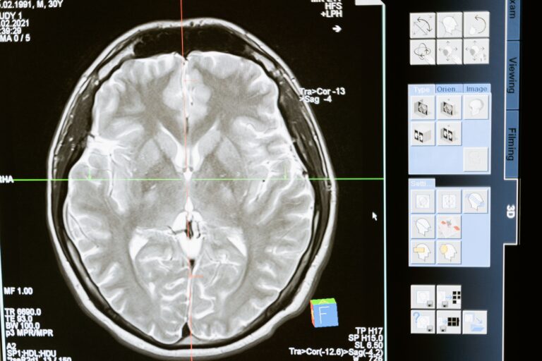 Brain Damage Caused By Extreme Heat